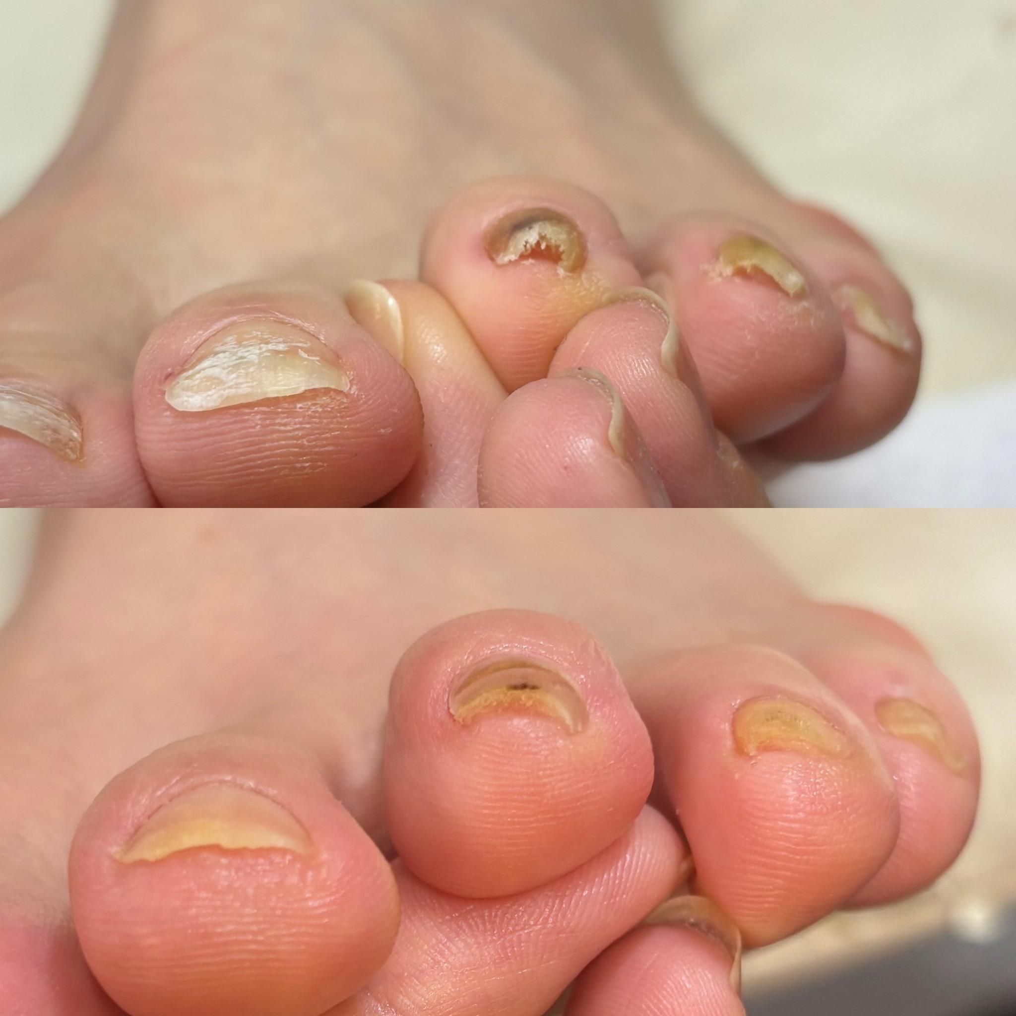 変形爪・巻き爪の症例写真